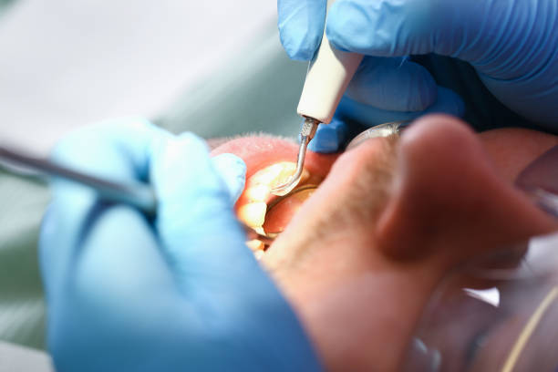 Best Emergency Treatment for Dental Infections or Abscesses in Janesville, WI